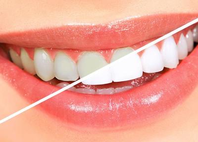 پنج روش ساده و طبیعی سفید کردن دندان ها