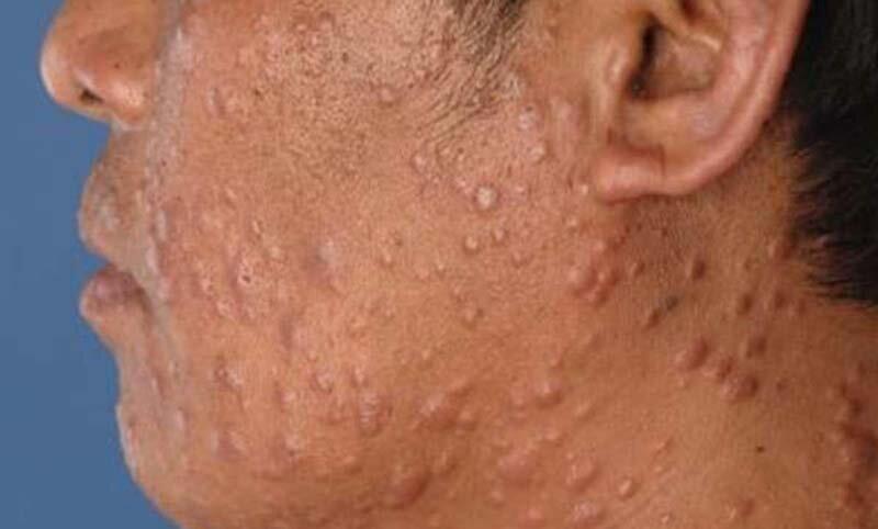 جذام همچنان در ایران قربانی می گیرد جذام همچنان در ایران قربانی می گیرد