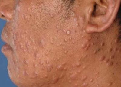 جذام همچنان در ایران قربانی می گیرد